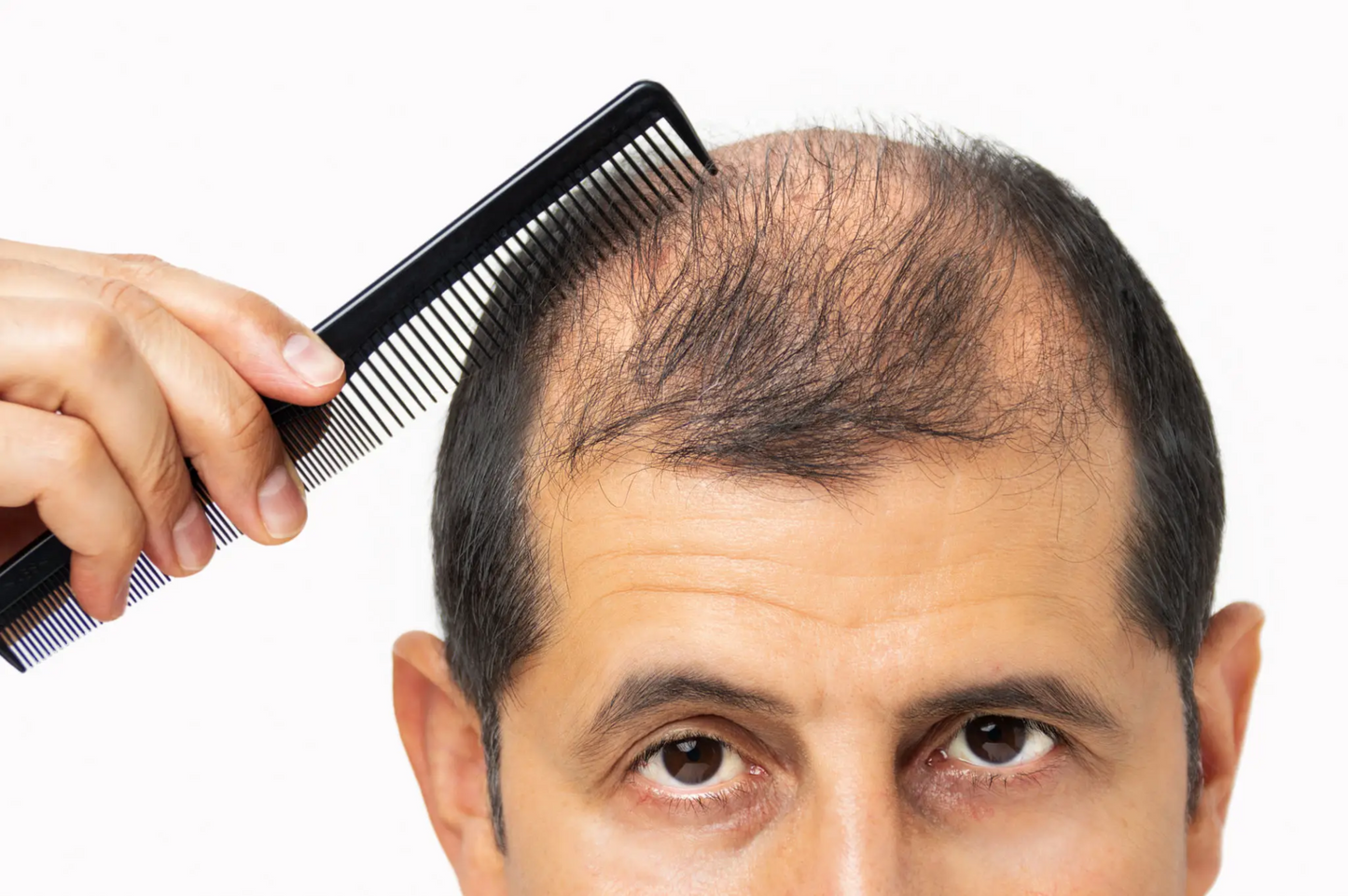 Man combing thinning hair, highlighting challenges of hair loss and the importance of advanced regrowth solutions like prescription shampoos, supplements, and treatments such as PRP and Minoxidil for effective hair restoration.